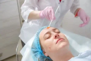 chemical peel Indianapolis